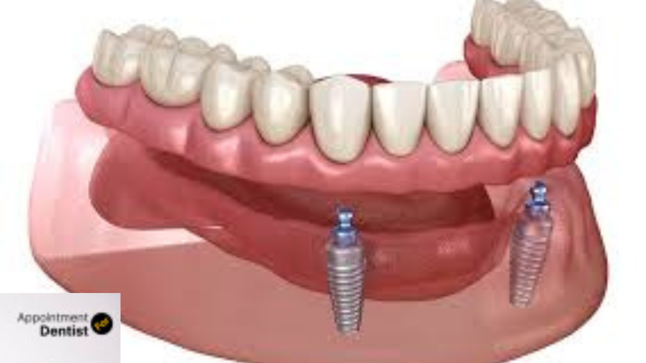 The Benefits of Dental Implants Over Dentures