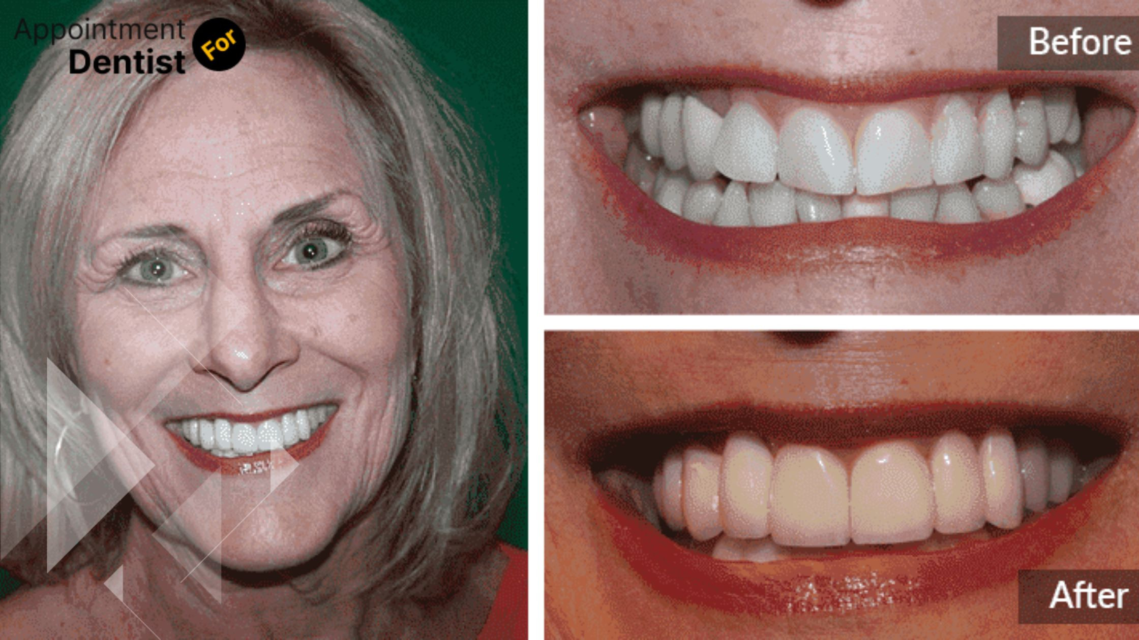 Everything You Need to Know About Full Mouth Reconstruction