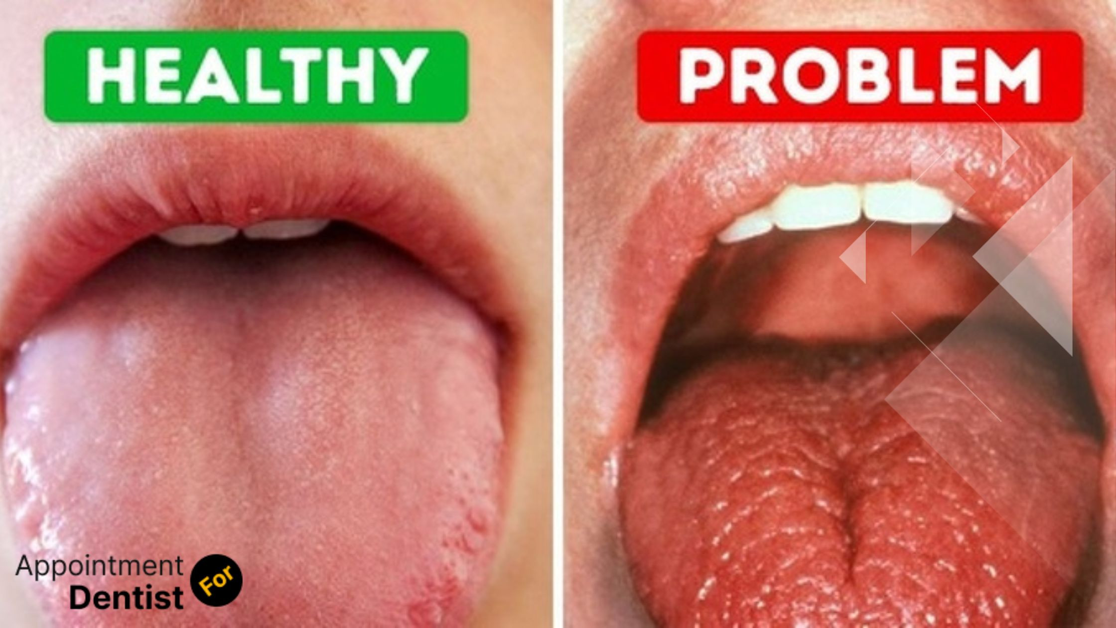 How to Treat and Prevent Dry Mouth (Xerostomia)