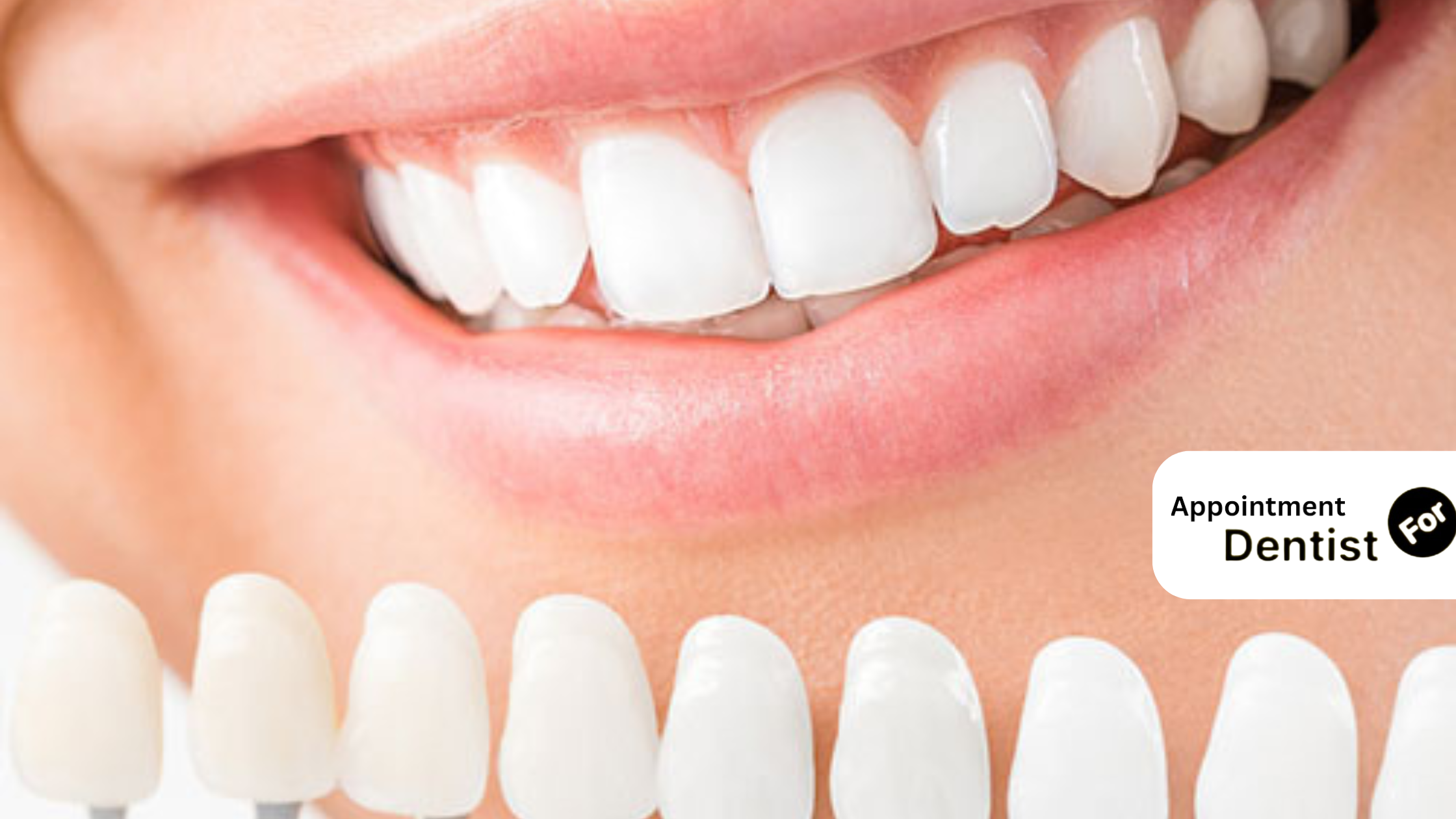 What You Need to Know About Porcelain Veneers