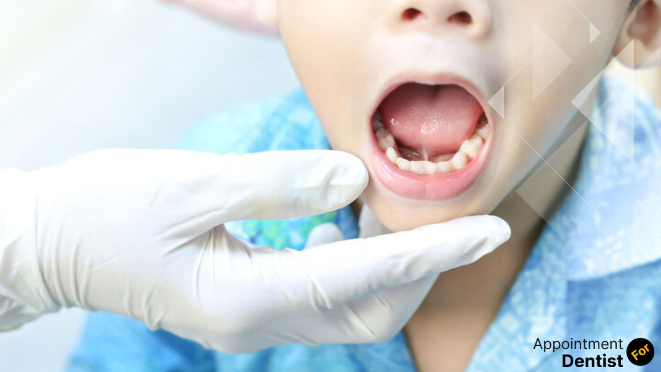 How Tongue Tie Affects Oral Health: Dental Considerations