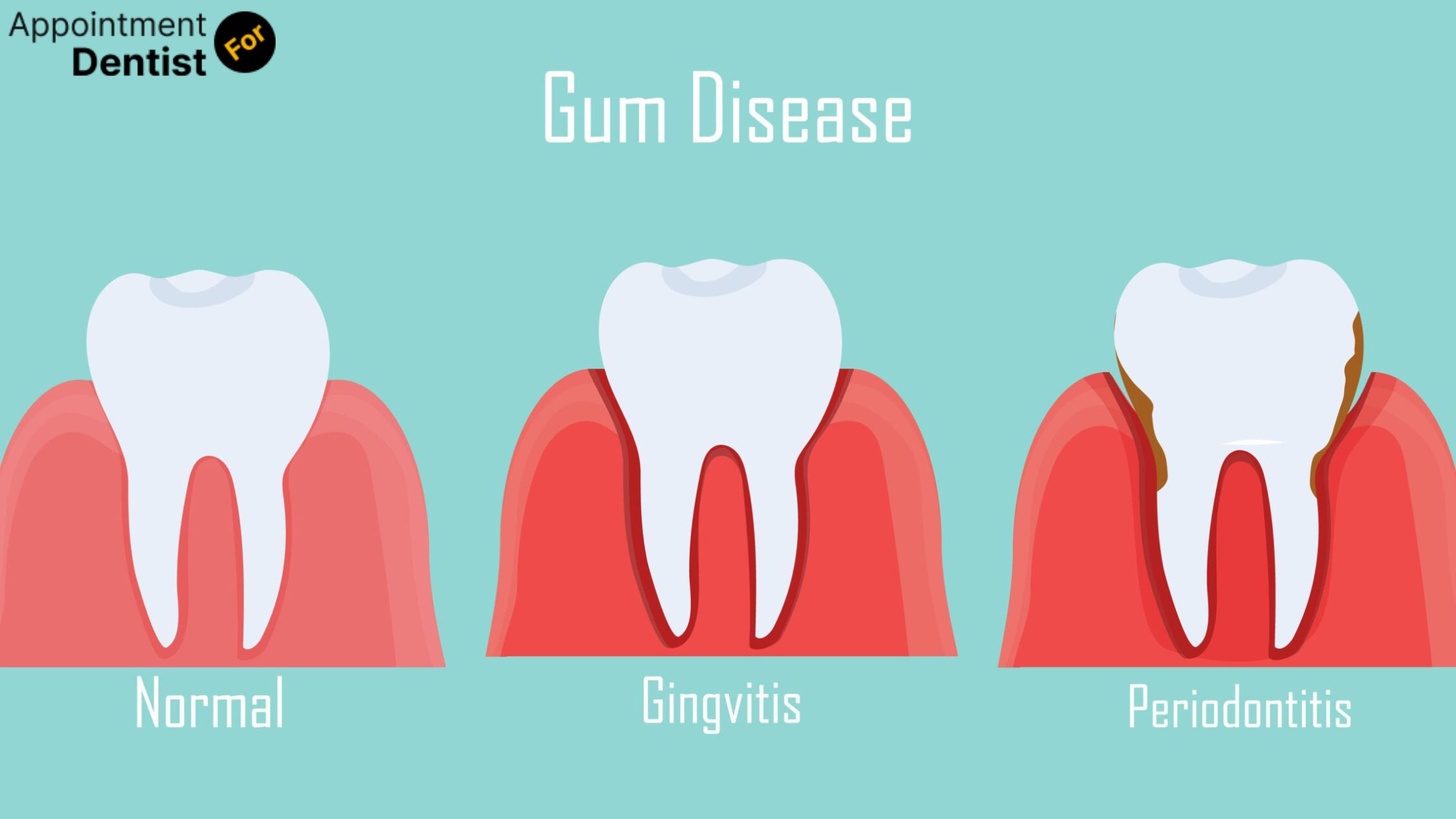 Treating and Preventing Gingivitis: Essential Tips