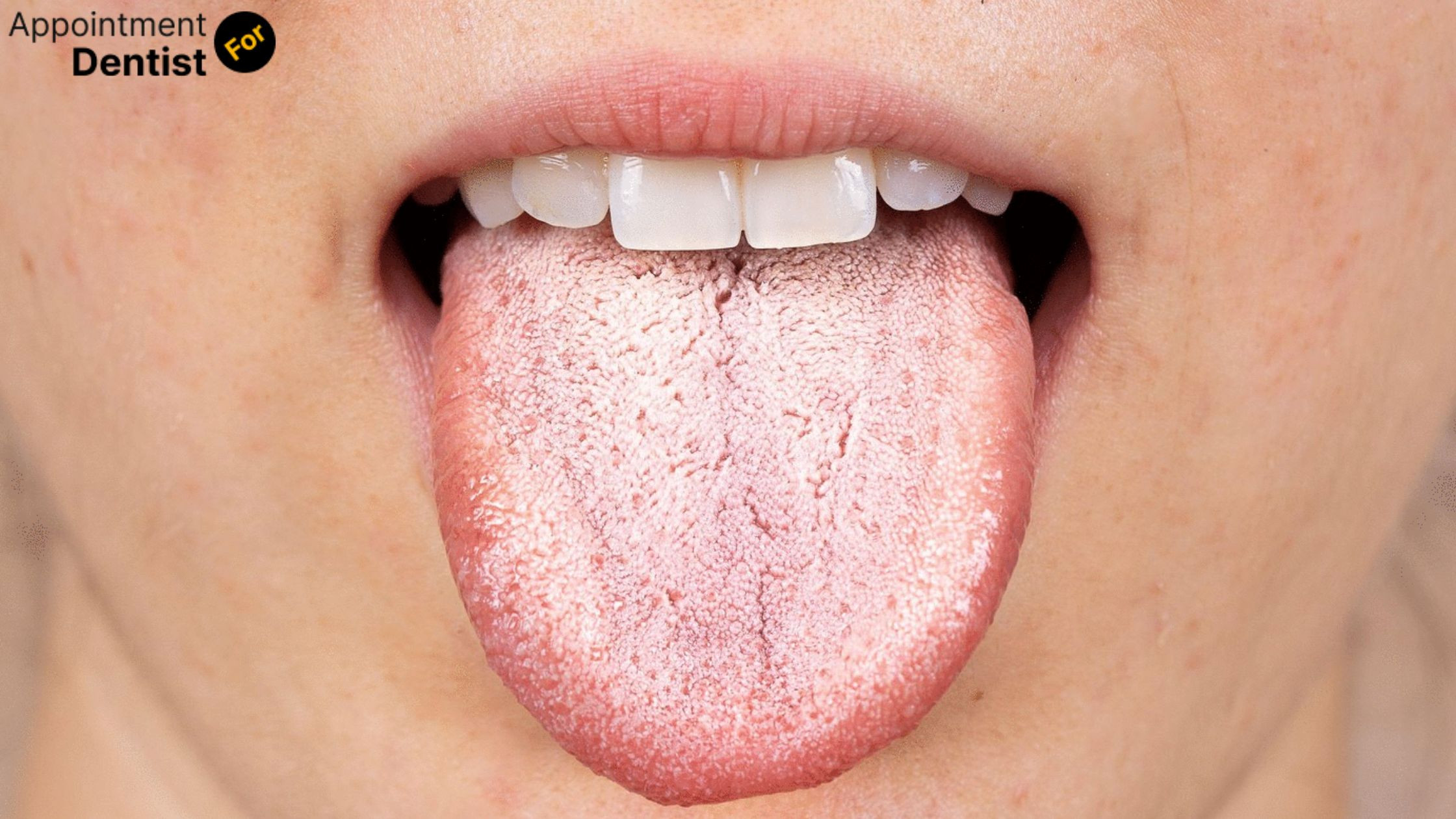 Addressing Oral Thrush: Causes and Effective Treatments