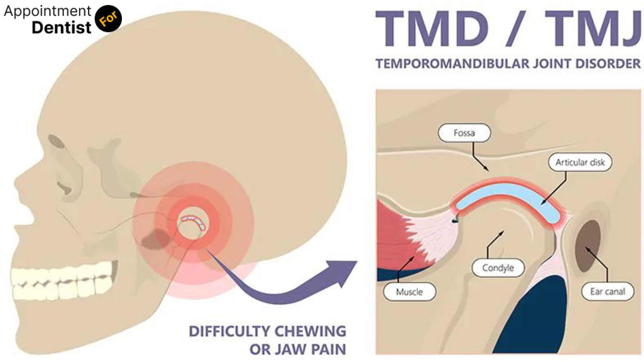 What You Need to Know About Temporomandibular Joint Disorder (TMJ)