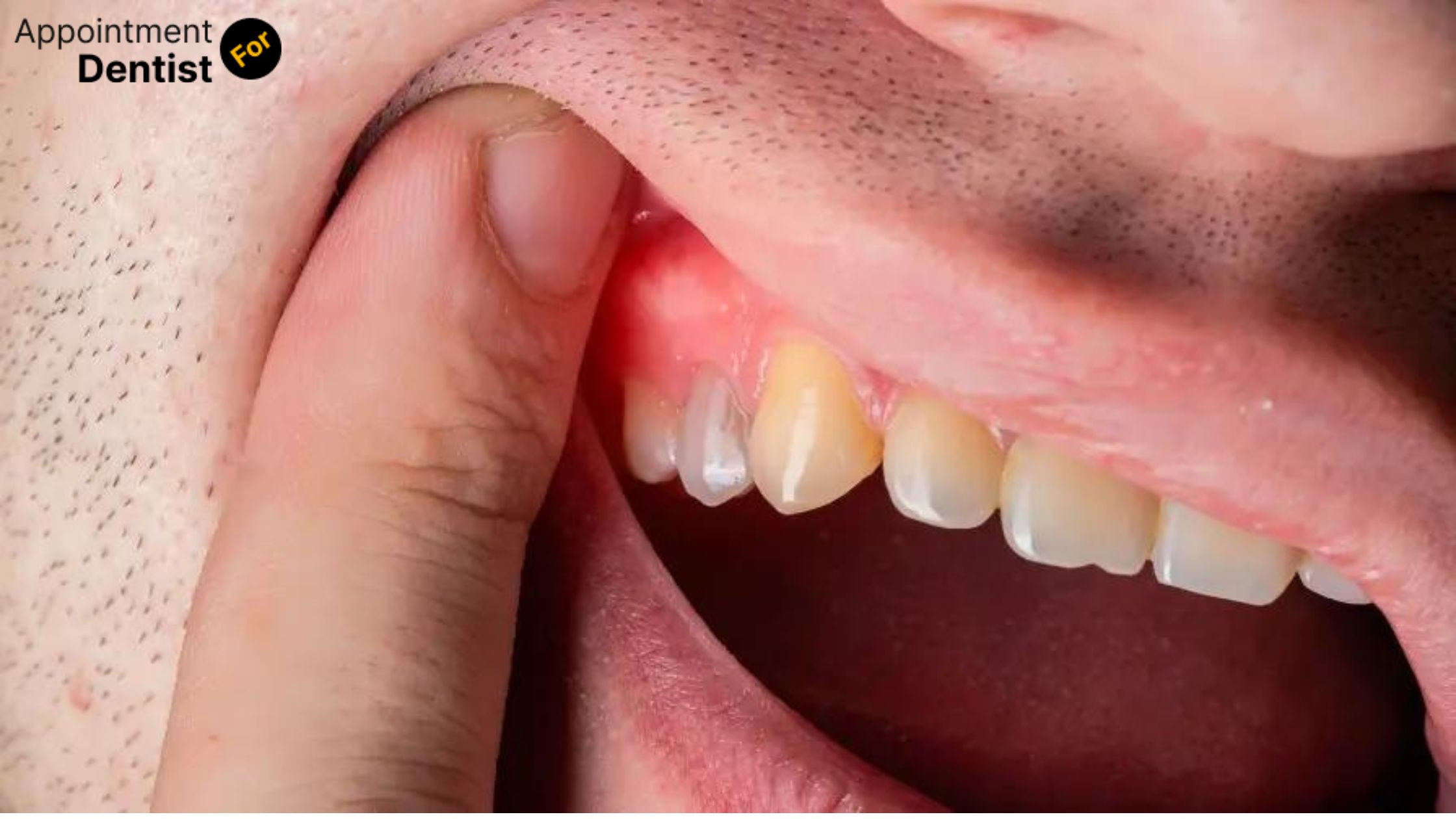 Identifying and Treating Dental Abscesses