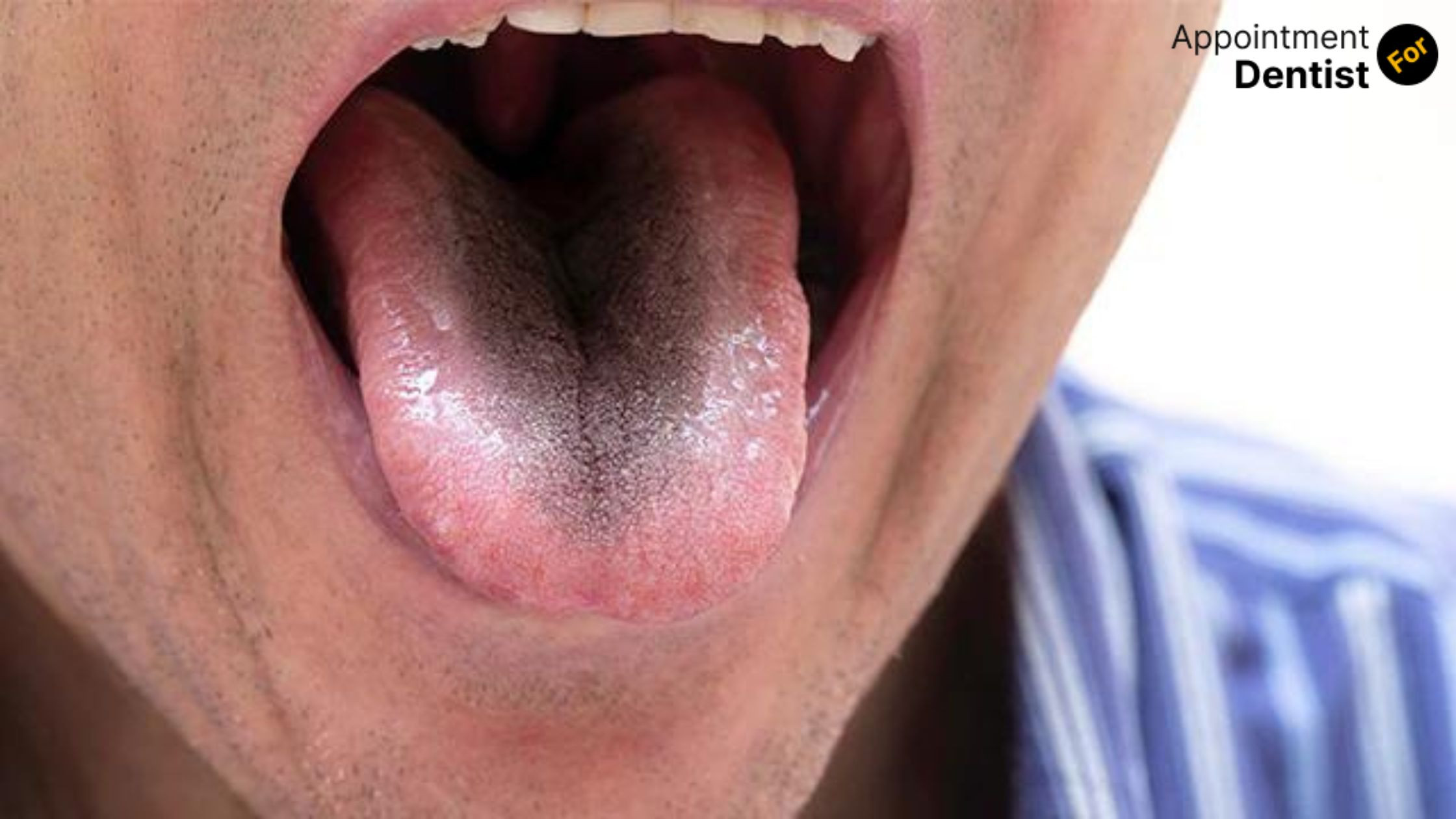 Treating Black Hairy Tongue: Causes and Solutions