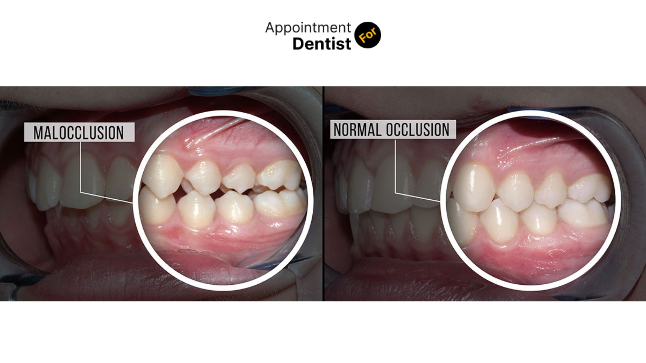 Dental Solutions for Addressing Malocclusion (Misaligned Teeth)