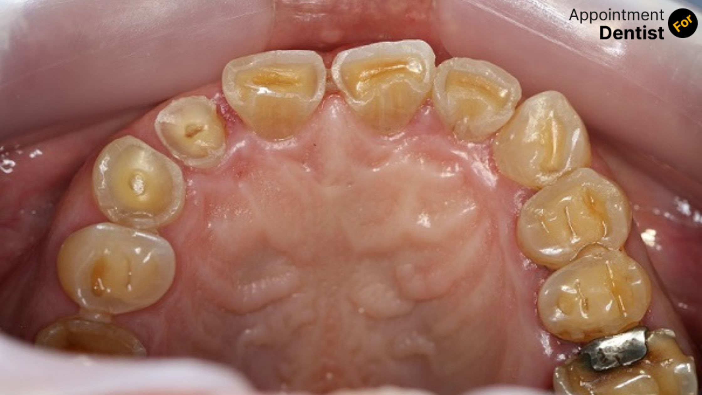 How to Treat and Prevent Tooth Erosion: Expert Tips