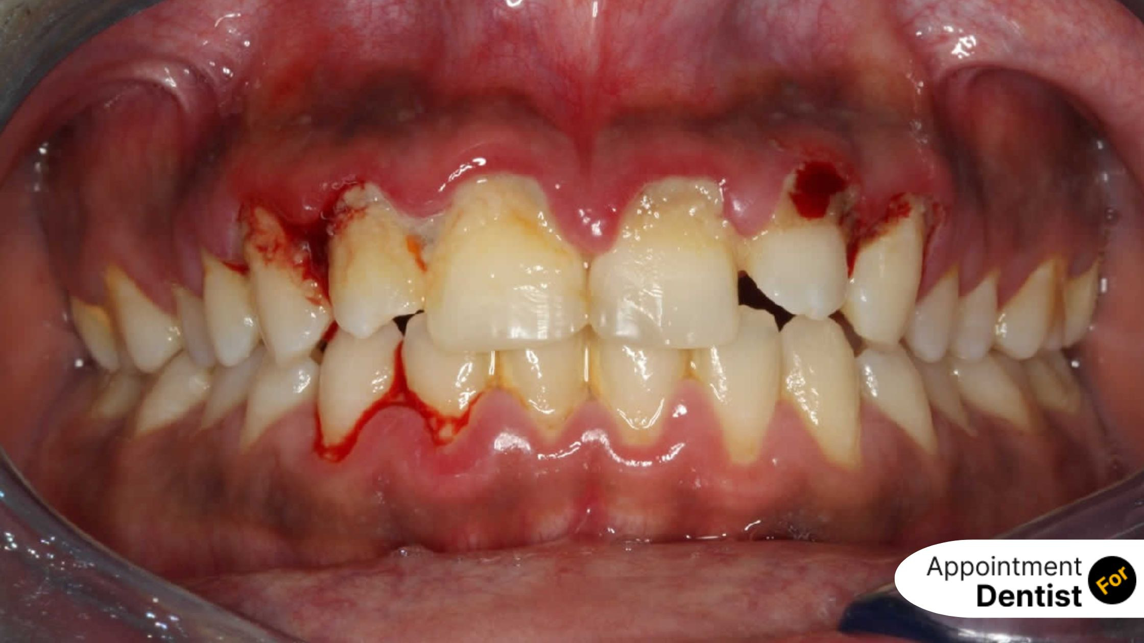 Understanding and Managing Trench Mouth (Acute Necrotizing Ulcerative Gingivitis)