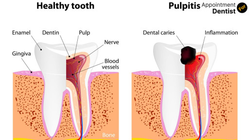 Effective Treatments for Dental Pulpitis (Inflamed Dental Pulp)