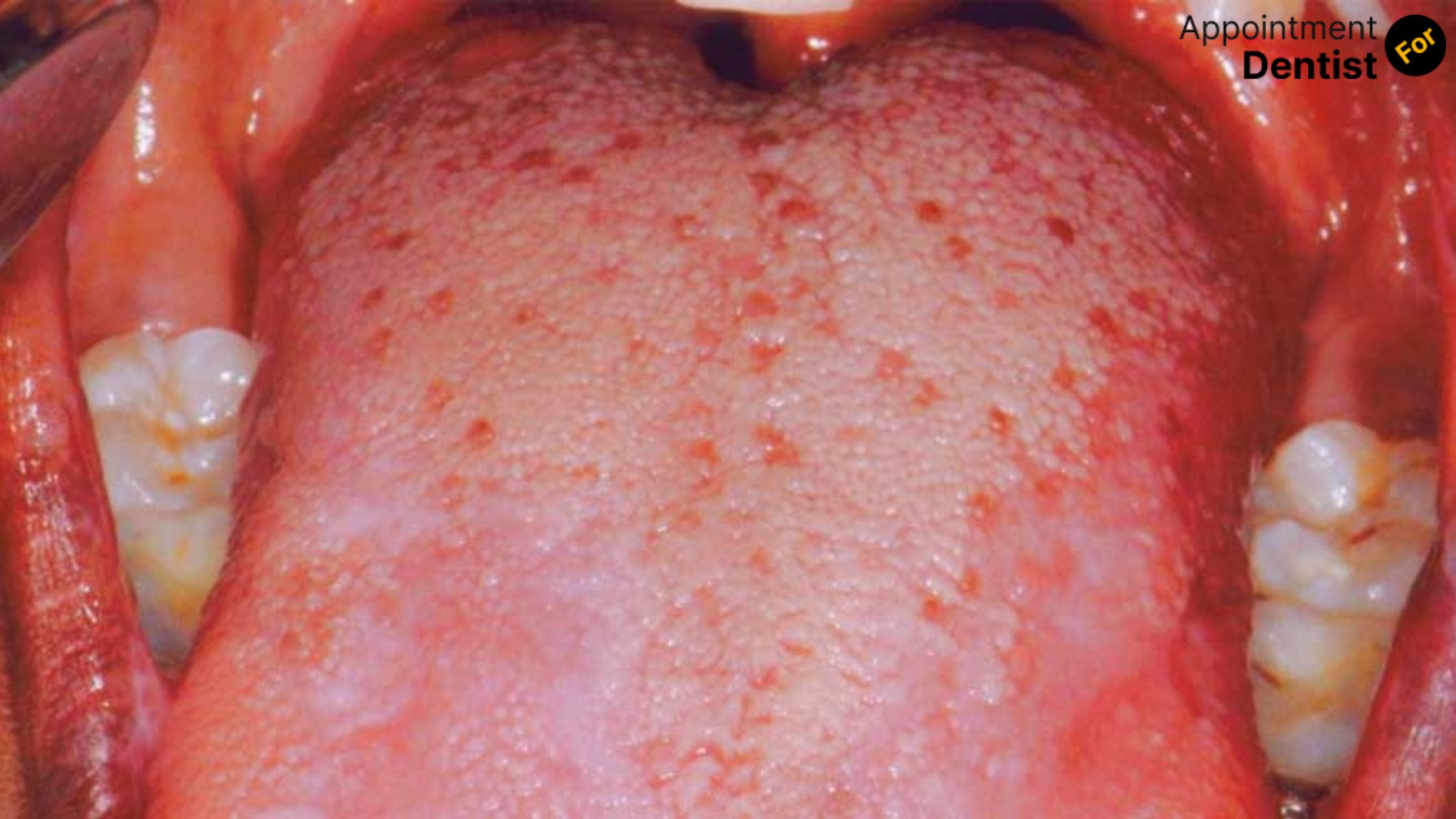 Dealing with Oral Lichen Planus: Symptoms and Treatments