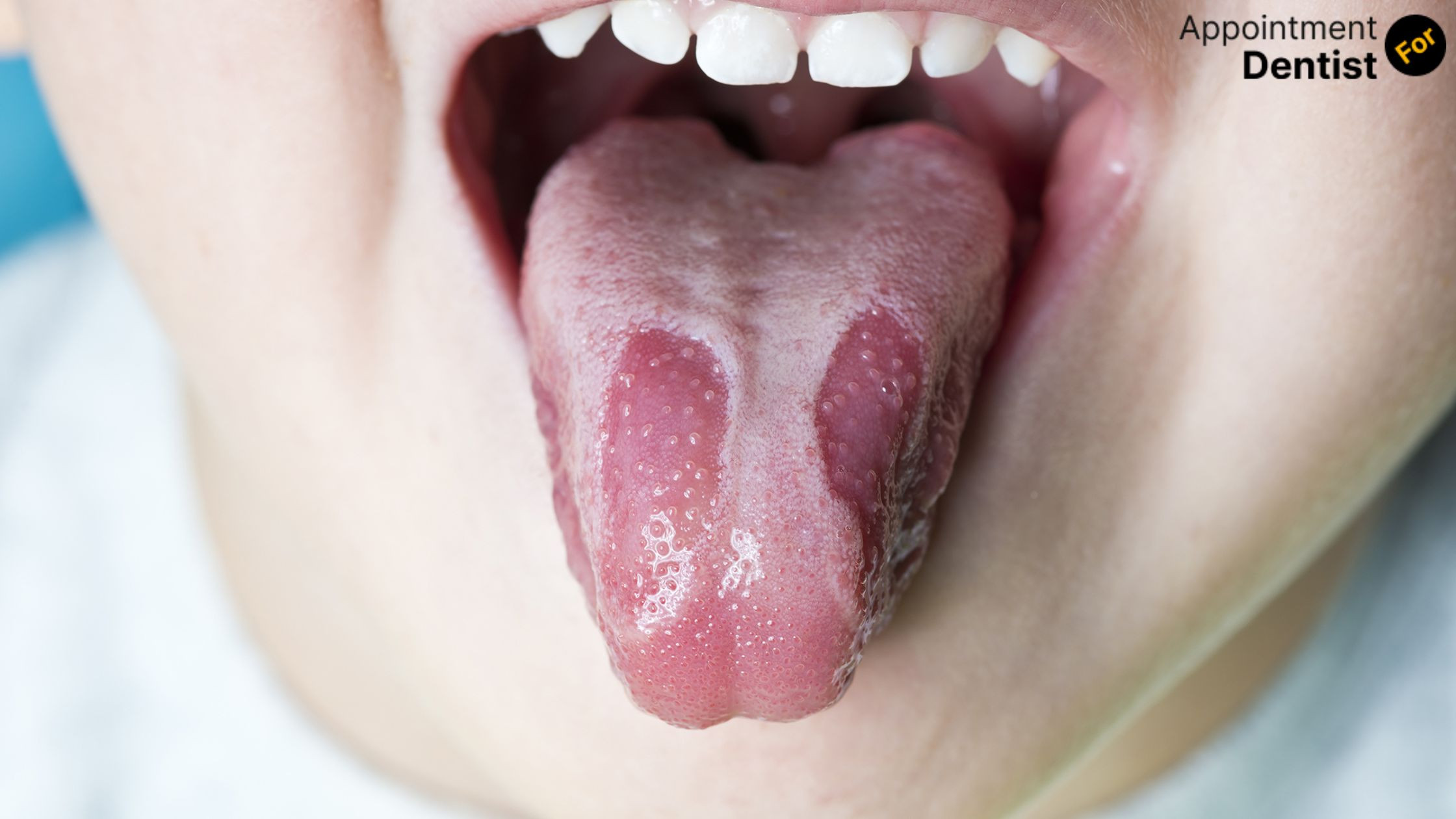 Addressing and Treating Geographic Tongue: What You Should Know