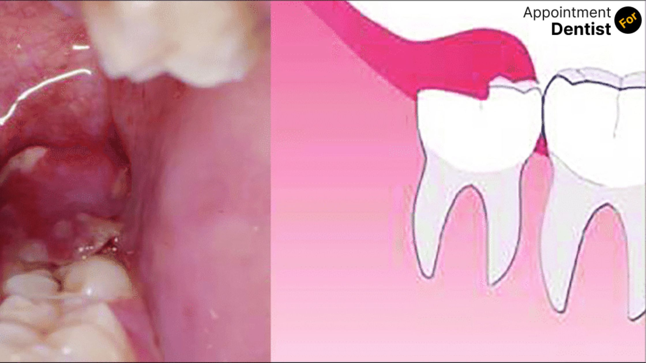 Managing and Preventing Pericoronitis