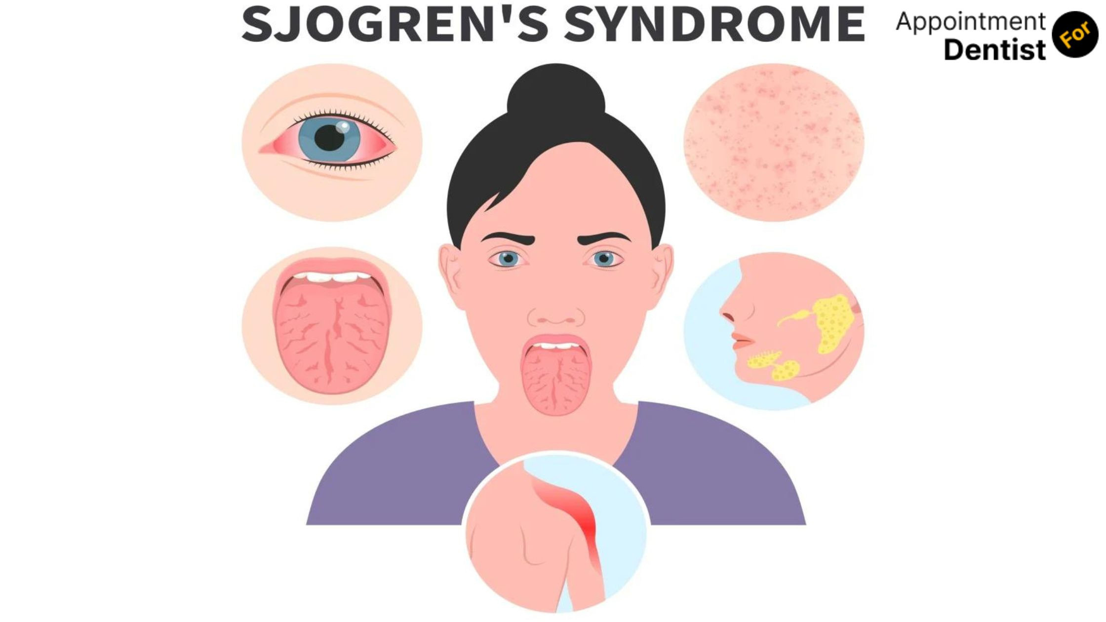 Primary Oral Health Care Tips for Dealing with Sjogren's Syndrome