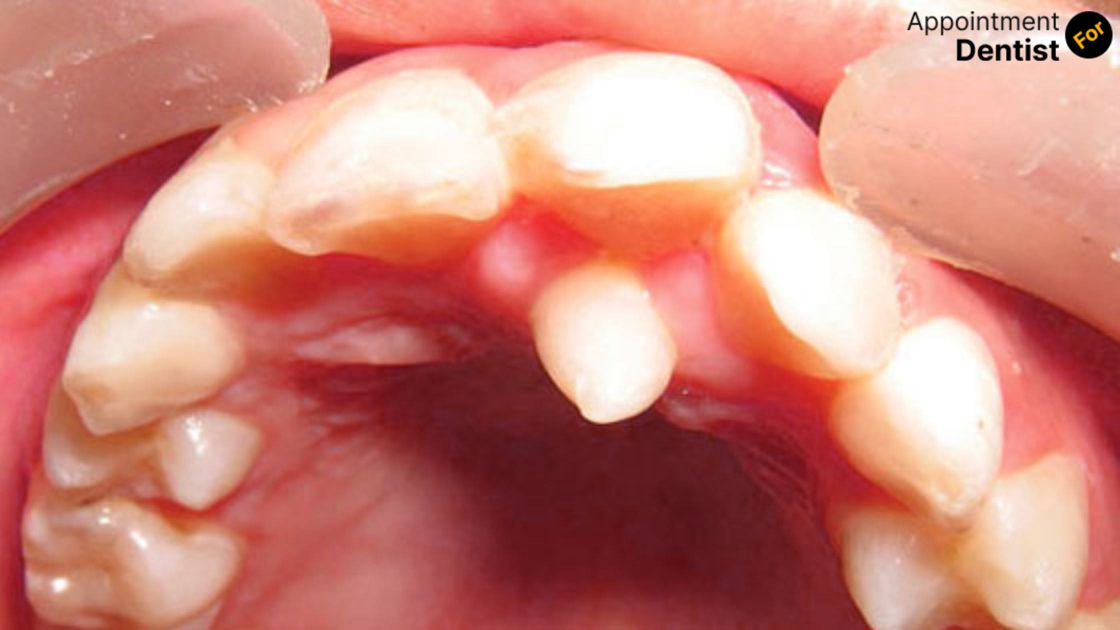 Dental Solutions for Treating and Preventing Hyperdontia (Extra Teeth)