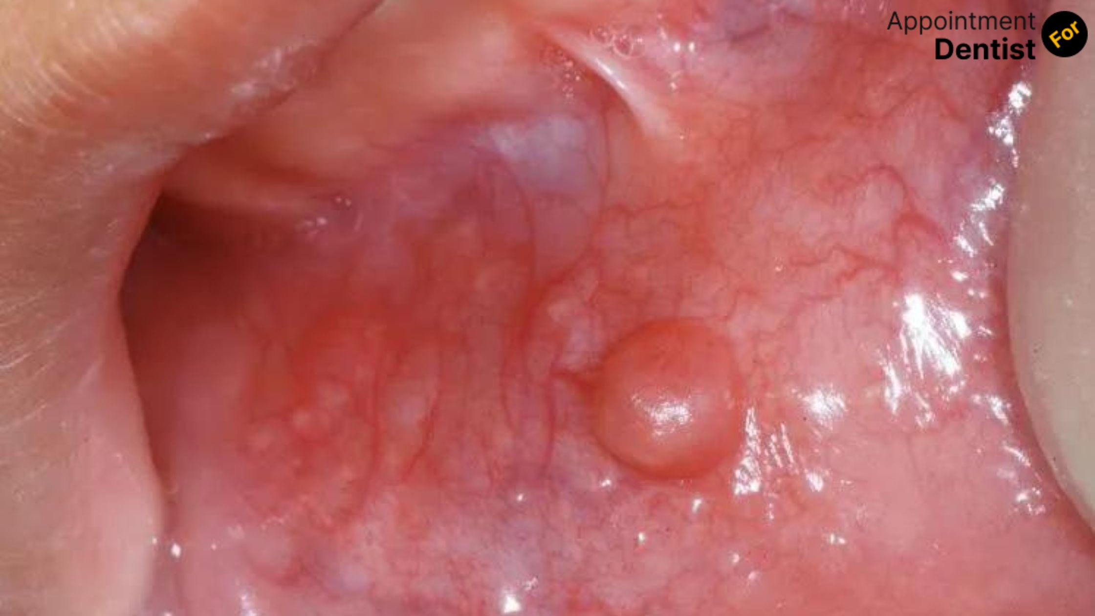 Understanding and Managing Oral Mucocele