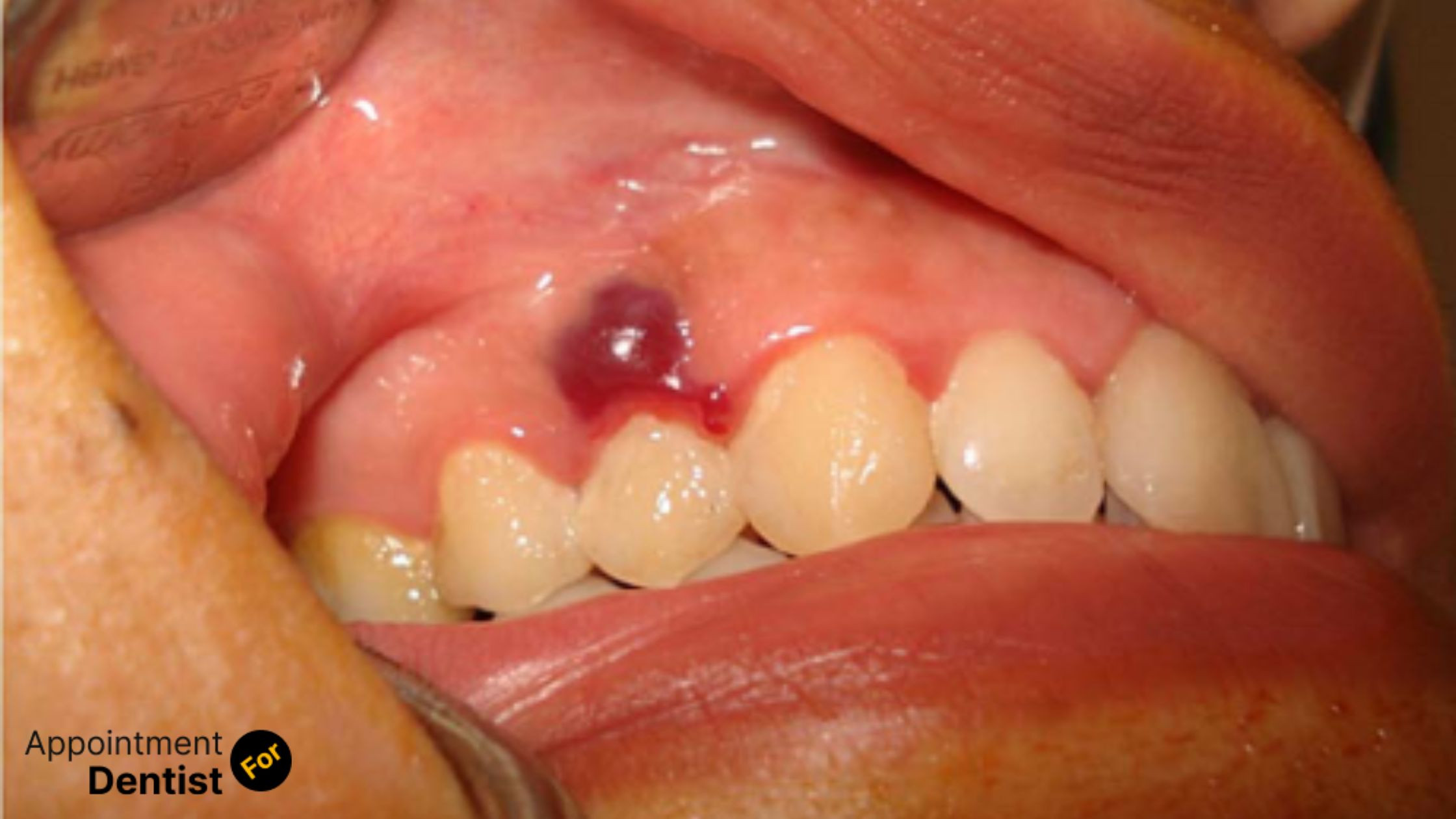 Treating and Preventing Oral Hemangioma