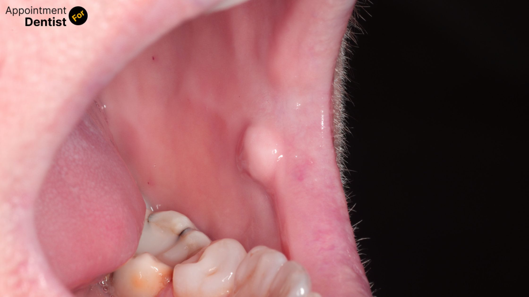 Understanding and Treating Oral Fibroma