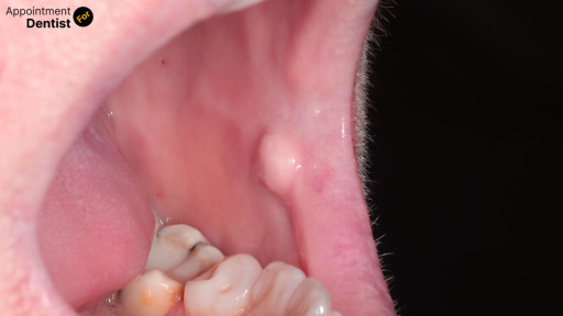 Understanding and Treating Oral Fibroma