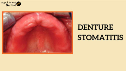 Treating and Preventing Denture Stomatitis