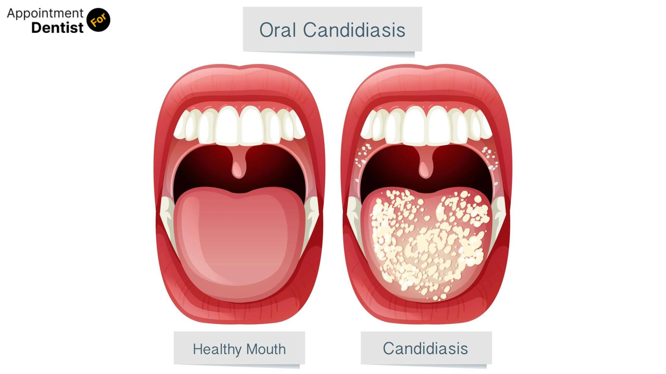 How to Address Oral Candidiasis in Immunocompromised Patients