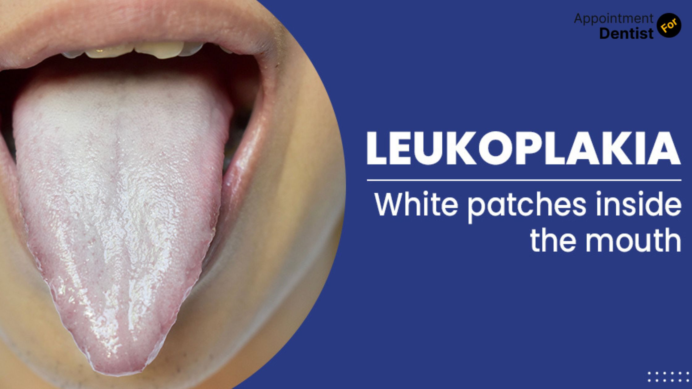 Exploring the Causes and Treatments of Oral Leukoplakia