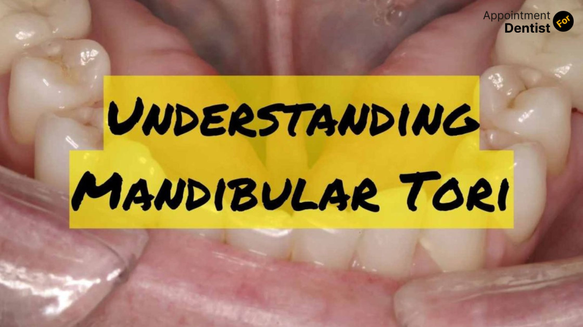 Understanding the Causes and Treatments of Oral Tori