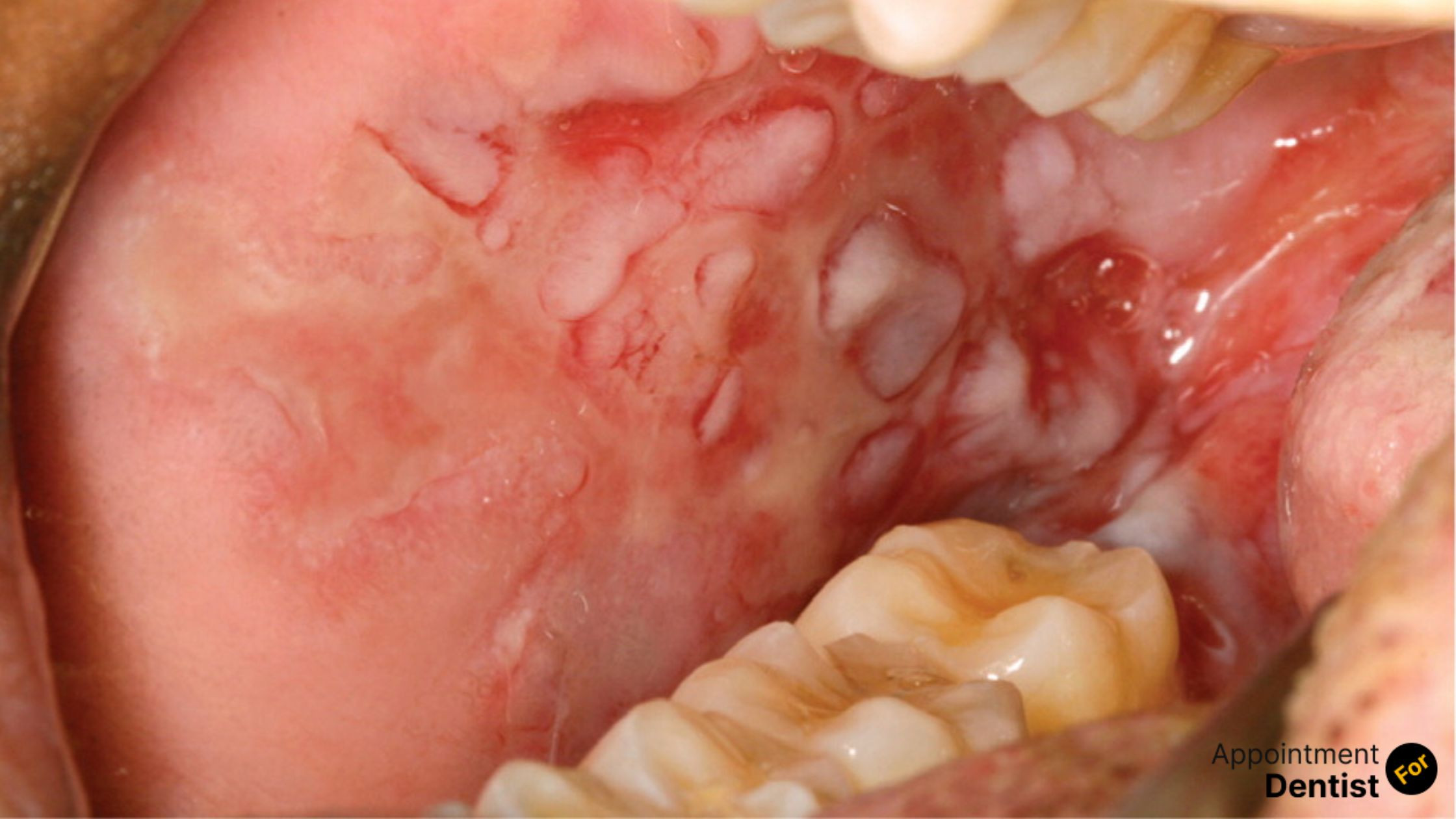 Identifying and Treating Oral Manifestations of Systemic Diseases