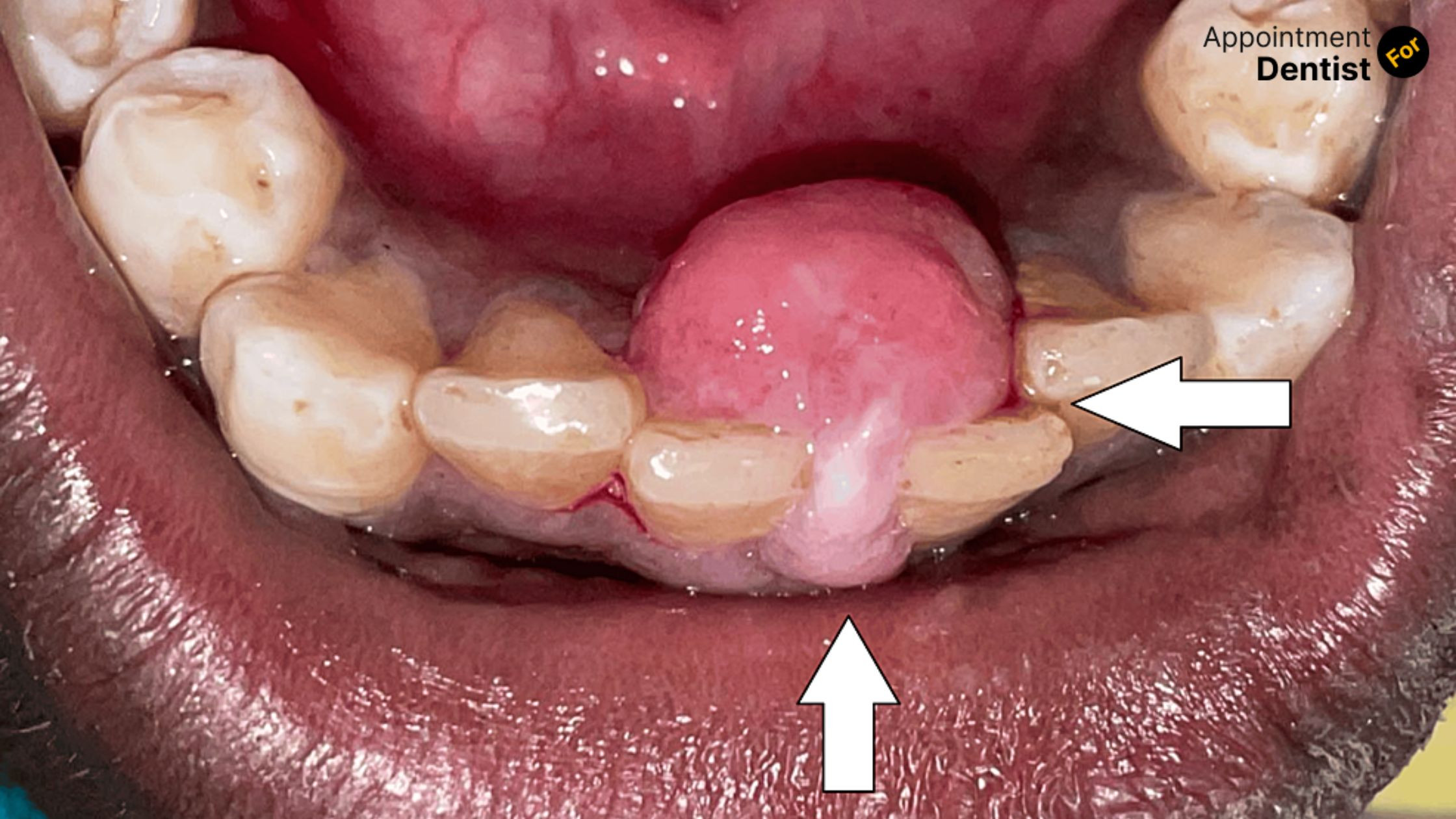 Addressing and Managing Oral Granuloma: Symptoms and Treatments