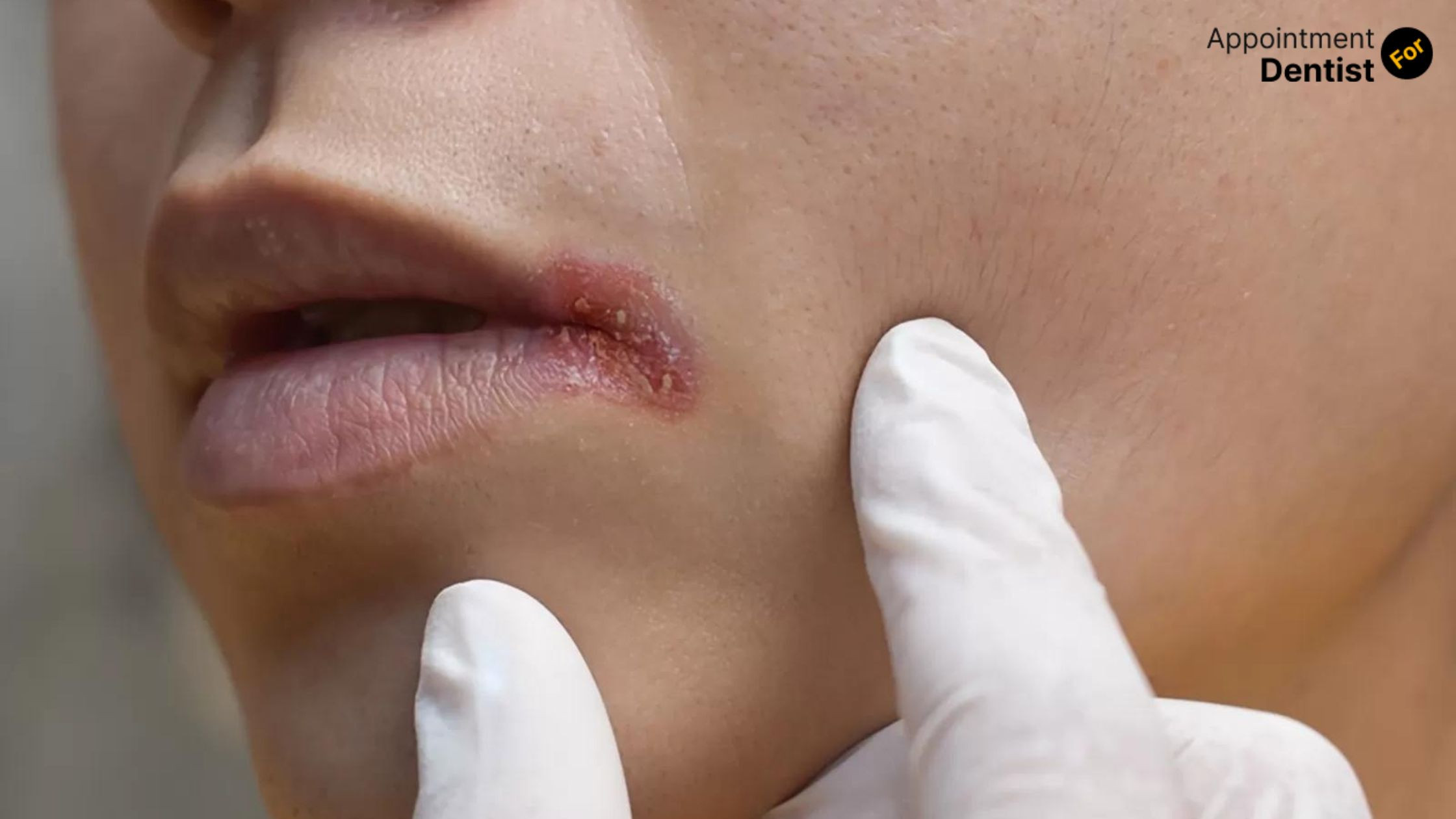 How to Treat and Prevent Angular Cheilitis