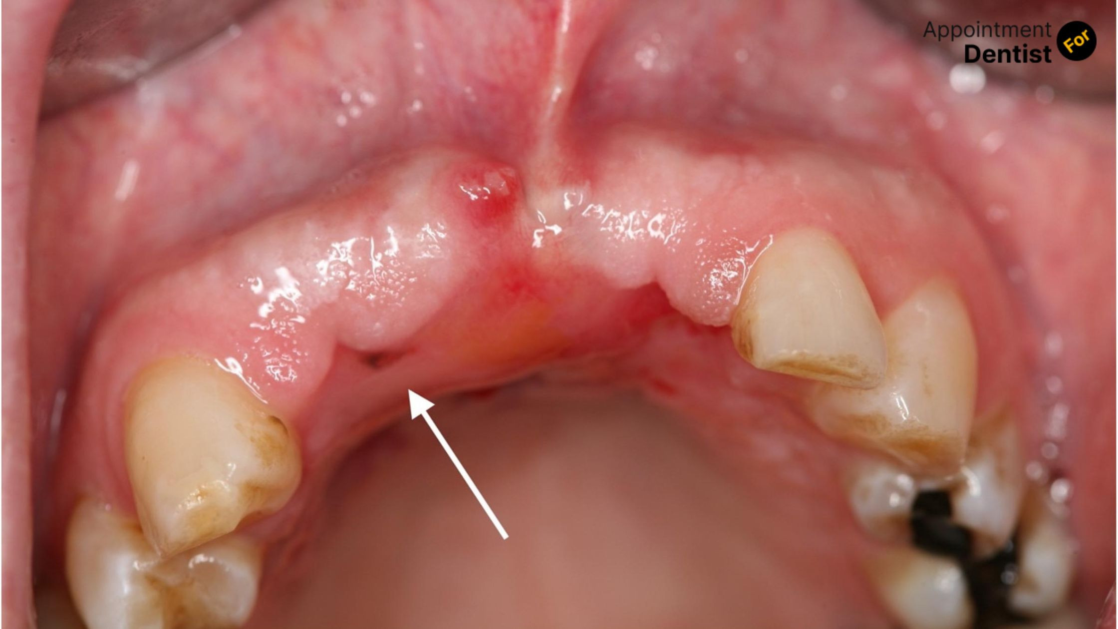 Treating and Preventing Mucosal Melanoma in the Oral Cavity