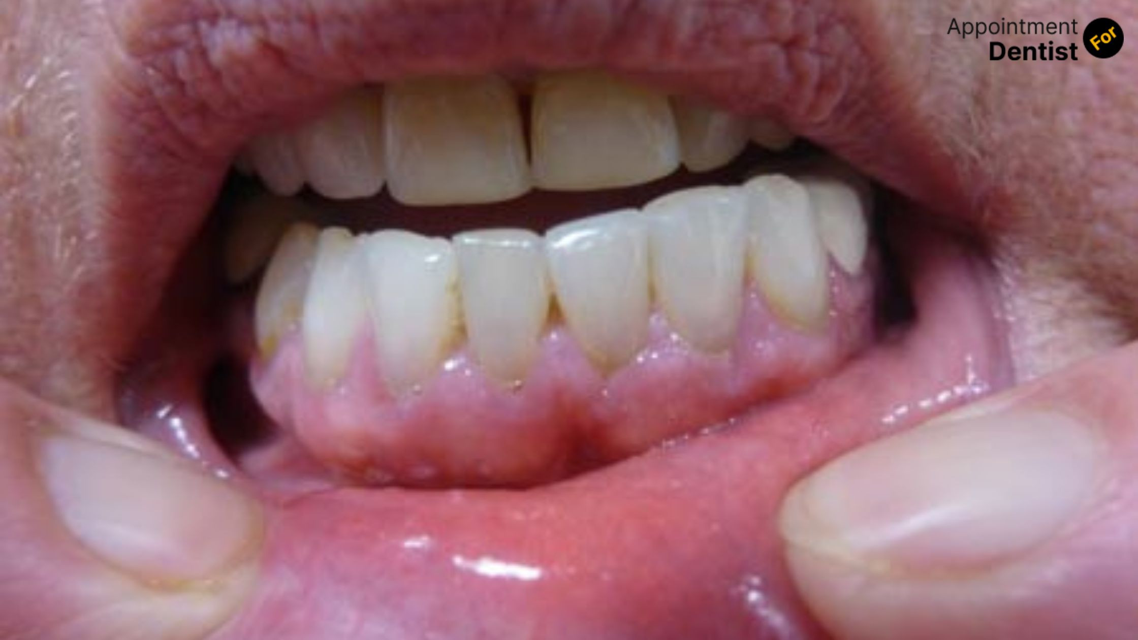 How to Prevent and Treat Oral Mucous Membrane Pemphigoid