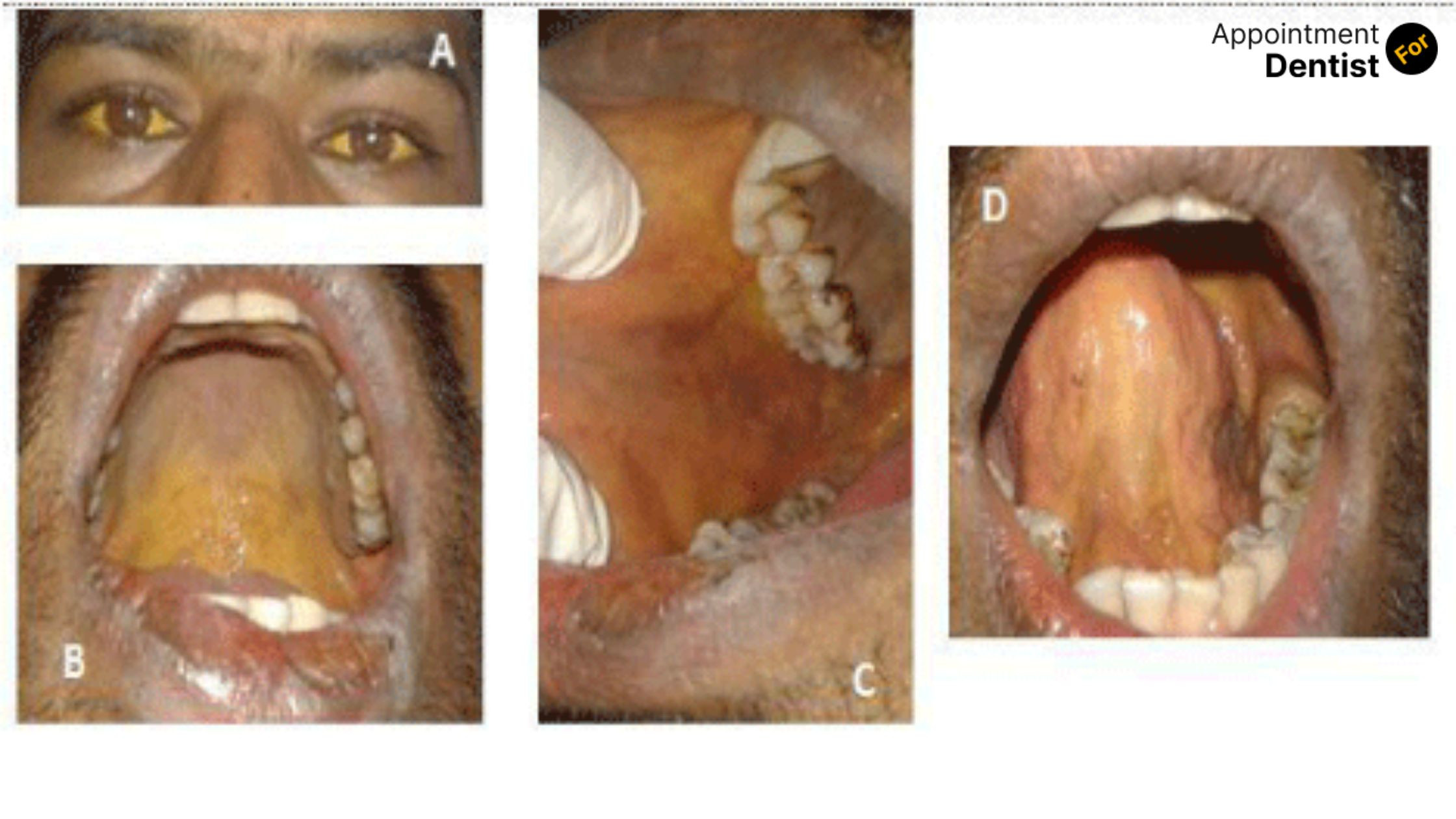 Understanding and Managing Oral Manifestations of Liver Disease